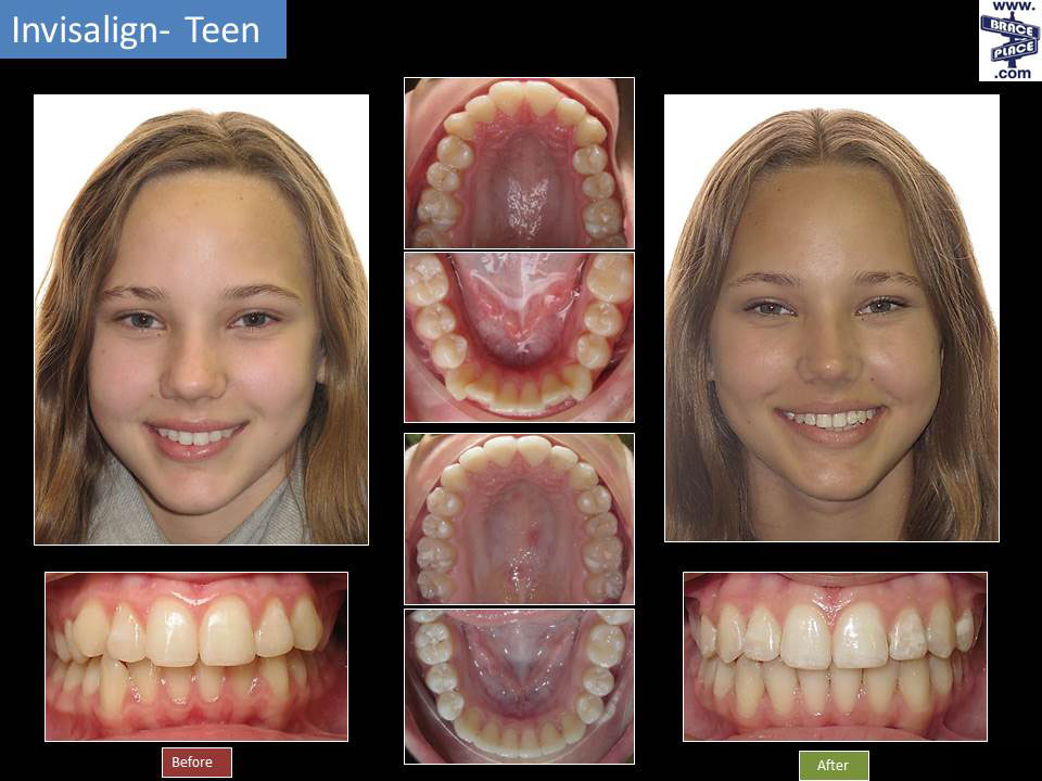 Invisalign® Before & After, Freehold Hightstown Manalapan NJ Orthodontist