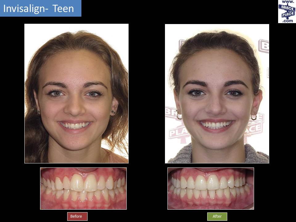 Invisalign Braces Before and After Review [VIDEO]