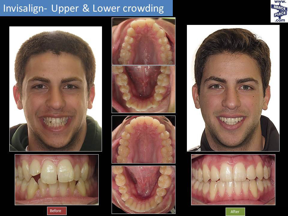 before and after braces adults