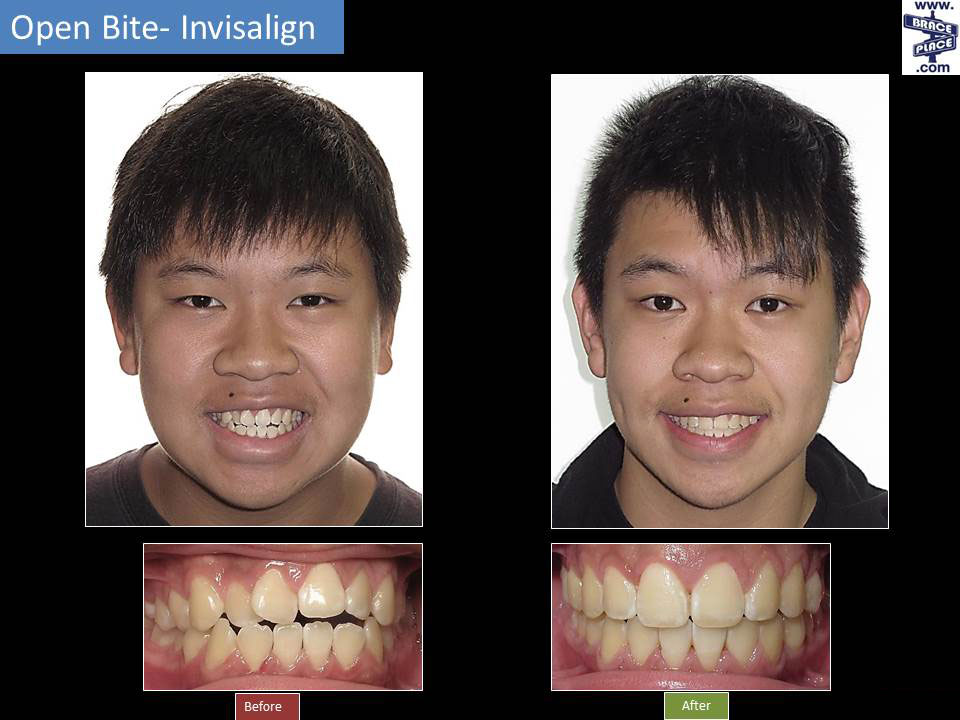 Invisalign® Before & After  Freehold Hightstown Manalapan NJ