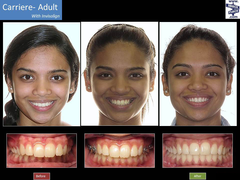 Invisalign® Before & After, Freehold Hightstown Manalapan NJ Orthodontist